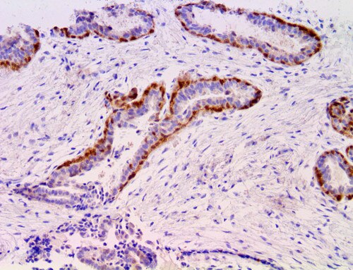 IHC of Maspin on an FFPE Breast Tissue